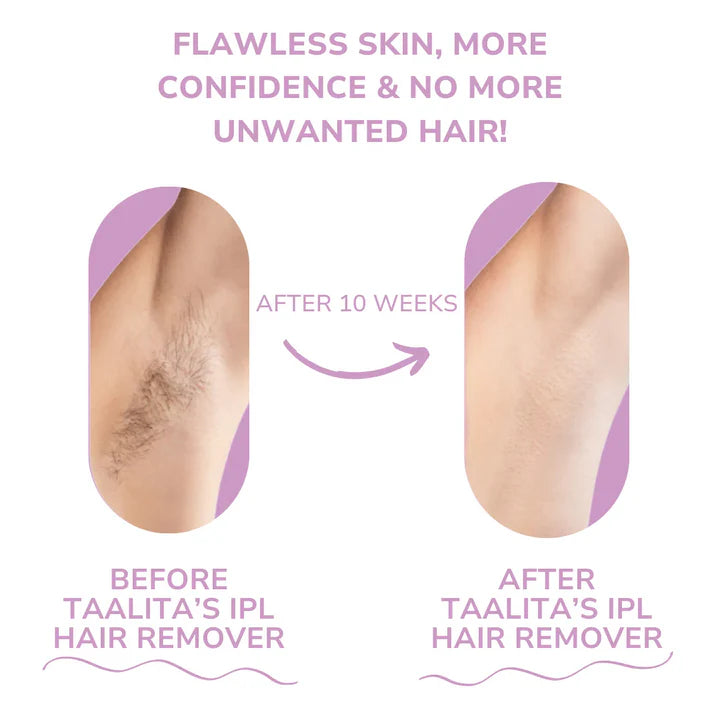 NUROA ™ IPL Hair Remover | Hair-Free Skin in Just Weeks
